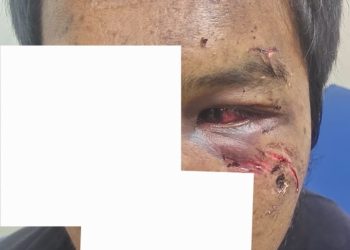 Pelaku Pengeroyokan Besas Berkeliaran, Polres Labuhan Batu Tak Bernyali Menahan Tersangka